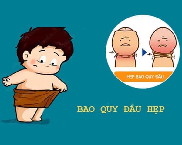 Mấy tuổi nên cắt bao quy đầu